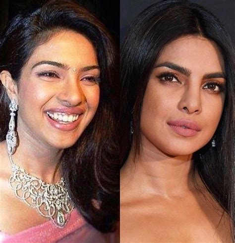 Priyanka Chopra Before And After Plastic Surgery😳 Celebrity Plastic Surgery Plastic