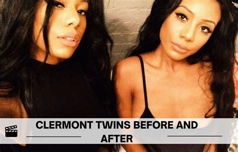 Clermont Twins Before And After Buttocks Cheek Chin And Lips Surgery