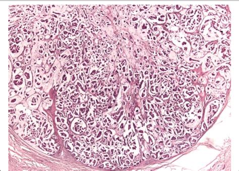 Histologic Image Of The Primary Carcinoma With Lakes Of Mucin