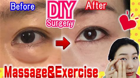 How To Remove Under Eye Bags Naturally In Days Massage Exercises YouTube