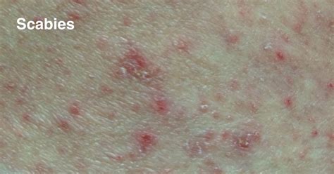 Scabies Is A Contagious Disease By David Robles Md Phd