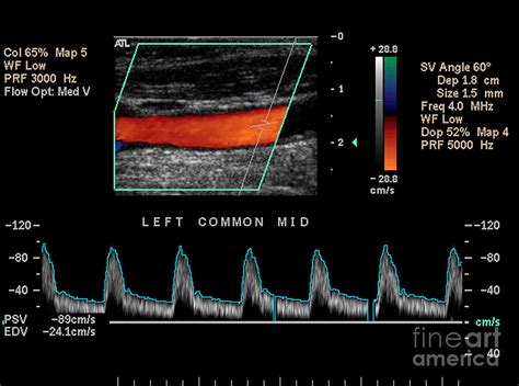 Carotid Duplex Ultrasound Exam Photograph By Living Art Enterprises