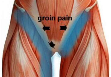 These muscles get a lot of use, and can be injured easily. groin pain, groin strain
