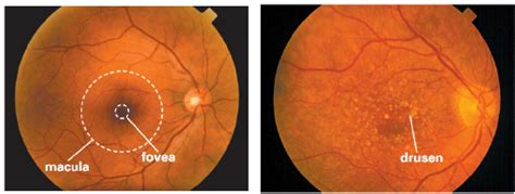 Photograph Shows A Normal Healthy Retina Left And Image From An Amd