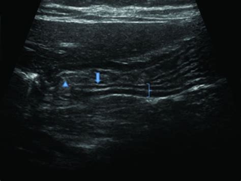 Novel Sonographic Clues For Diagnosis Of Antral Gastritis And
