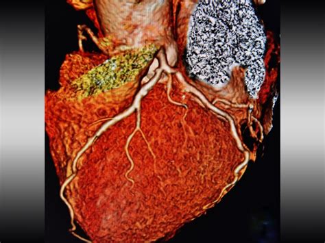 Scot Heart Angiotomografía Computarizada Coronaria Vinculada A Menos