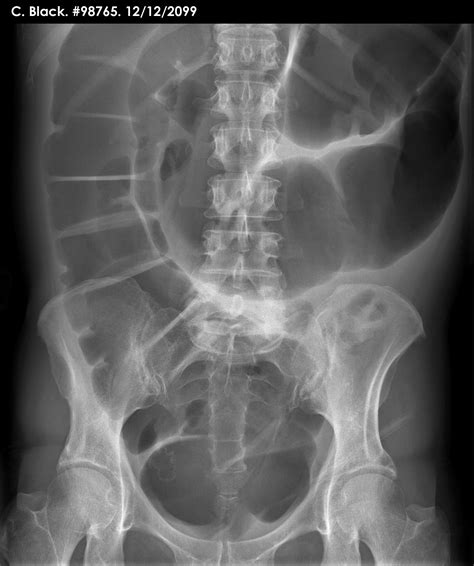 It is of no help in the diagnosis of acute appendicitis or certain other acute conditions such as ruptured ectopic pregnancy. Abdominal X-ray - Scenario 3 - Scenario image 1