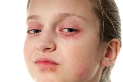 Allergic Reaction Skin Rash Close View Portrait Of A Girl S Face