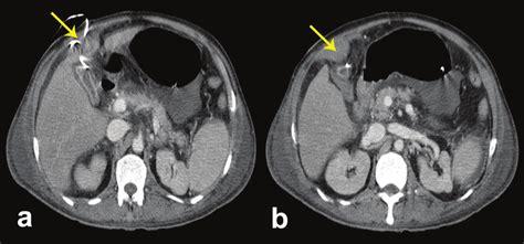 Ct Performed On Day 3 In A Patient Who Underwent Percutaneous