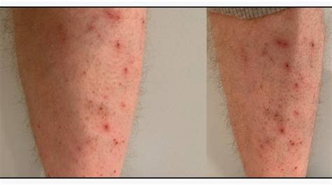 Dry Skin Patches Causes Symptoms And More