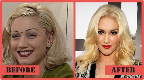 Gwen Stefani Plastic Surgery What Happened To The Actresss Face