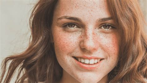 Pigmentation How Redheads Can Treat It How To Be A Redhead