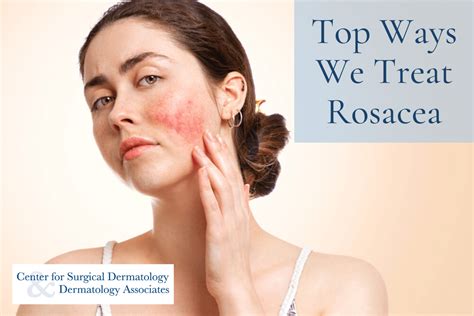 Top Ways Our Dermatologists Treat Rosacea For A Clear Complexion