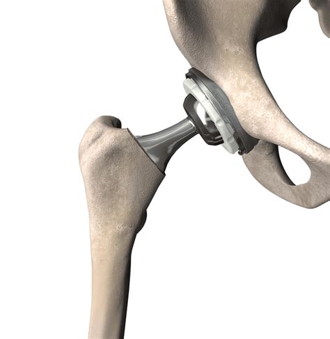 What Is The Best Surgical Approach For Hip Replacement New Braunfels