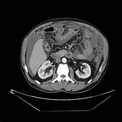 Learn about symptoms, prognosis and treatment options now. Malignant peritoneal mesothelioma | Radiology Reference ...