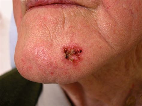 Diagnosis And Removal Of Skin Cancers Of The Face Ceri Hughes Oral