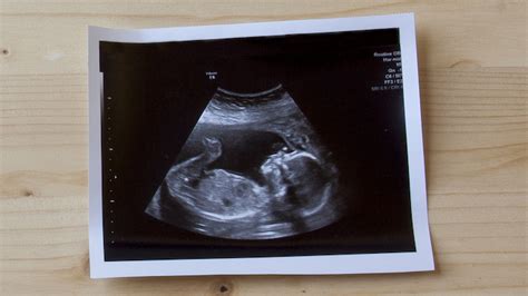 What To Say About A Baby Scan That Looks Just Like Every Other Baby