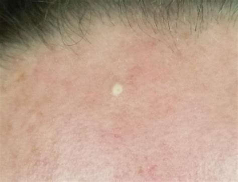 White Bump Not A Pimple Dermatologyquestions