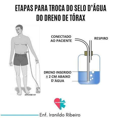 Drenagem Torácica Passo A Passo