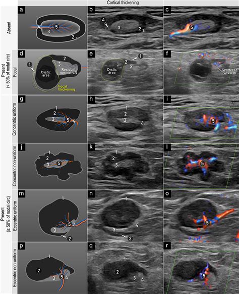 Terms Definitions And Measurements To Describe Sonographic Features Of