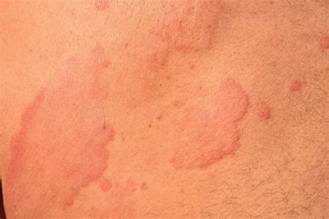 What Causes Hives What To Know About Urticaria Best Health Canada