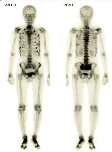 Bone Scan Observation Image Shows An Increased Uptake In The Bilateral