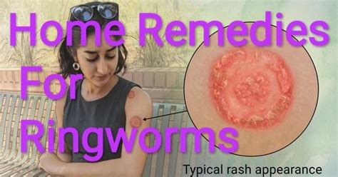 Home Remedies For Ringworms Must Be Known By Everyone Ringworm Is A