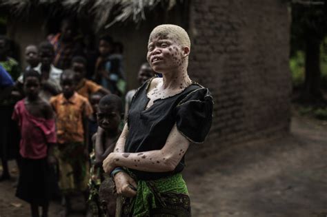 Attacks On Albinos In Malawi For Body Parts Used In Witchcraft Soaring Says Amnesty Ibtimes Uk