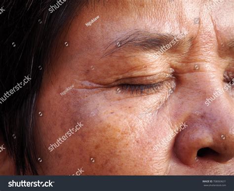 Asian Old Woman Skin Problem Melasma Stock Photo 708069631 Shutterstock