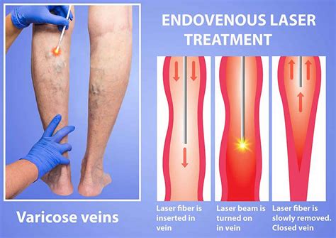 Endovenous Laser Ablation Indications Technique And Complications