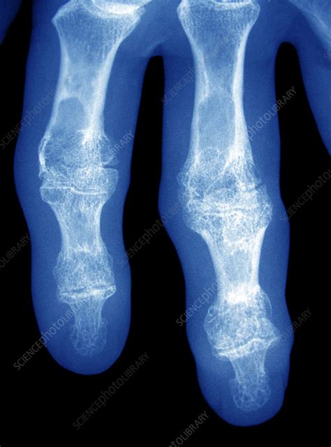 Arthritic Fingers X Ray Stock Image C0226828 Science Photo Library