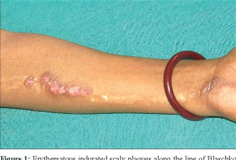 Disseminated Discoid Lupus Erythematosus With A Linear Lesion On The