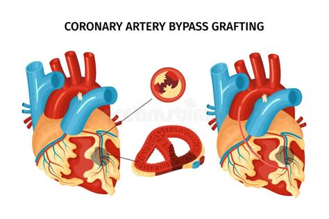 Heart Bypass Surgery Stock Vector Illustration Of Coronary 104169802