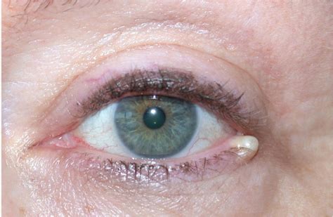 Classification And Management Of Eyelid Disorders Ento Key