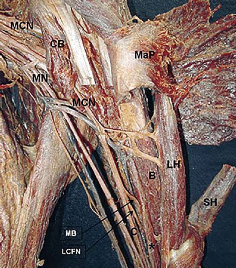 They are divided into two distinct compartments of the arm. Anterior view of left arm. MaP: major pectoral muscle; CB ...