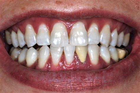 Relevante kriterien dabei sind die qualifikation des arztes und die zahl der bereits durchgeführten operationen. 10 Dinge zum Bleaching - WHITE SMYLE Dental ...