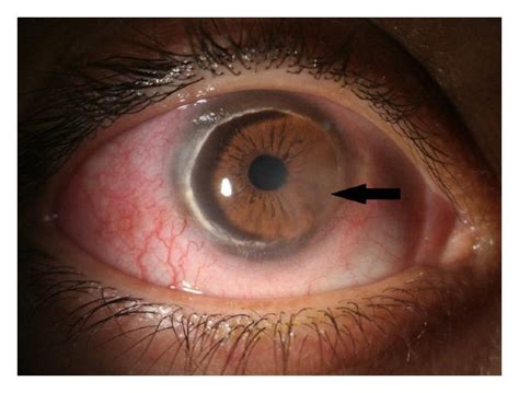 Photograph Of The Right Eye Showing Conjunctival Injection And