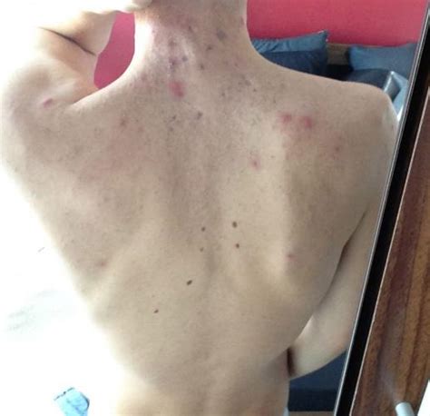 Purple Marks From Cystic Acne Back Of Neck Help Pictures Scar Treatments