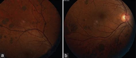Congenital Hypertrophy Of The Retinal Pigment Epithelium Eyewiki
