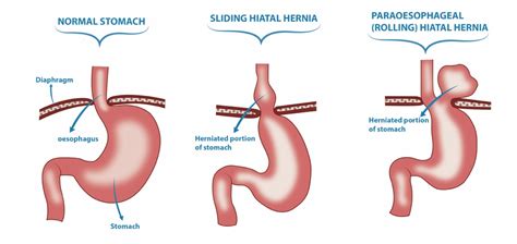 Types Of Hiatal Hernia Surgery