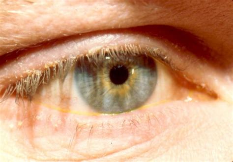 Blepharitis Eye Infections