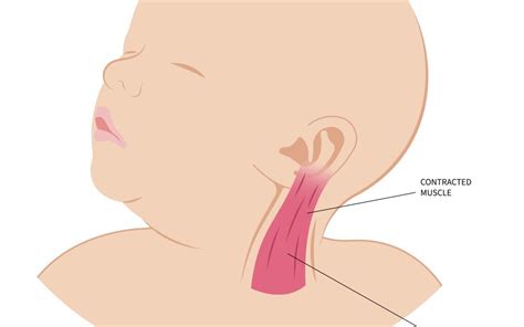 Torticollis Causes Symptoms And Treatment The Willow Clinic