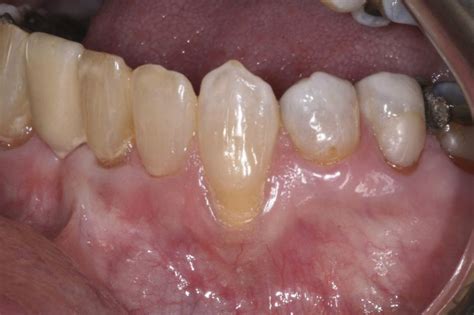 Treatment Of A Miller Class Ii Gingival Recession Defect June