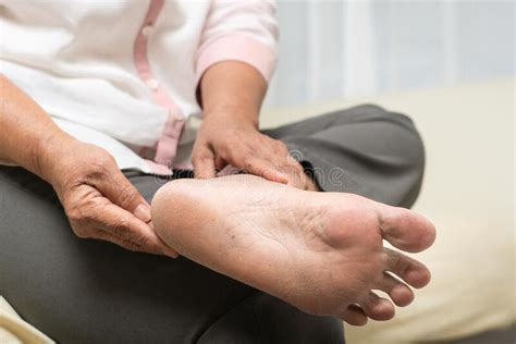 Dry Skin And Cornea On Senior Woman Foot Stock Photo Image Of