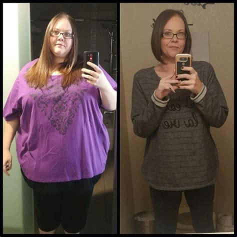 Gastric Bypass Surgery Before And After Pictures Past