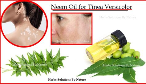 Neem Oil For Tinea Versicolor Natural Remedies And Natural Essential