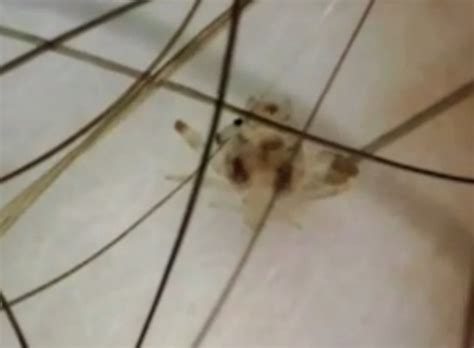 Man 56 Gets Treated To Microscopic View Of His Pubic Louse