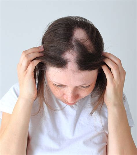 Alopecia Areata Hair Loss Causes Symptoms And Treatments