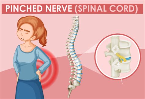 What Causes A Pinched Nerve And How Chiropractic Can Help