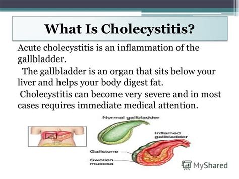 Acute cholecystitis is swelling of the gallbladder. Презентация на тему: "Acute Cholecystitis created ...